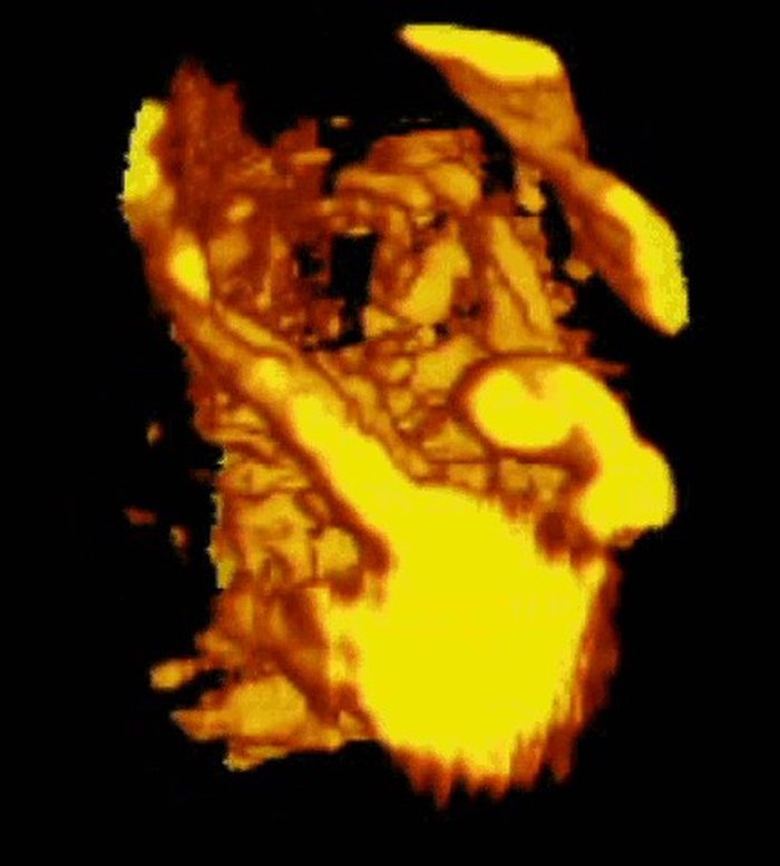 Reconstrução em 3D por power Doppler da vascularização da placenta e do cordão umbilical