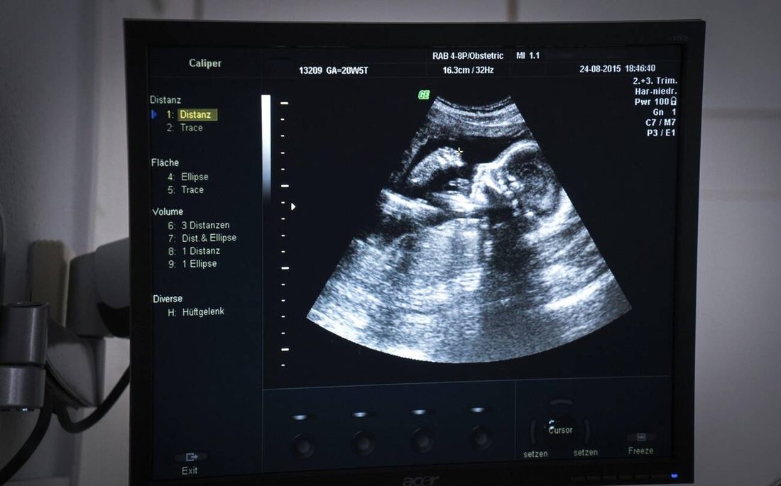 Monitor de aparelho de ultrassom exibindo uma imagem de ultrassonografia obstétrica
